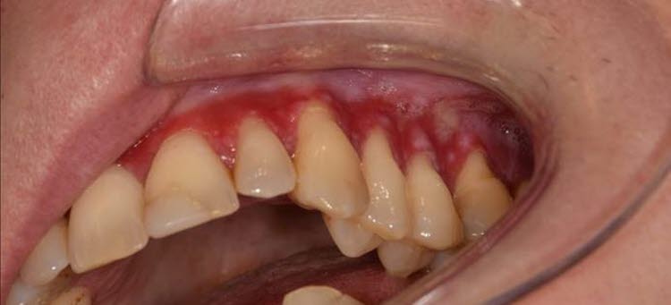 Närbild på tandkött i en mun som är rött och irriterat runt tänderna